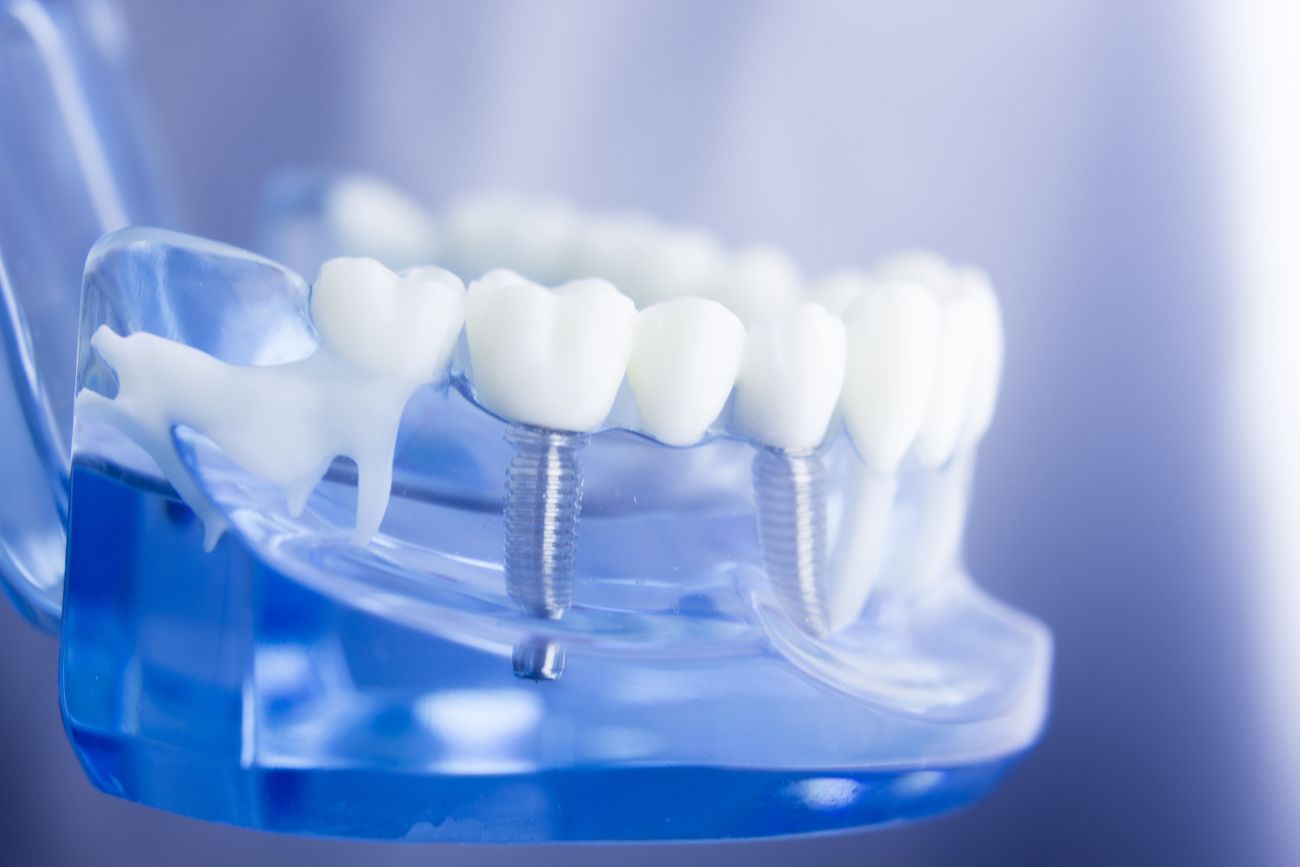 What Are the Most Popular Dental Implant Options Available Now? Stuff